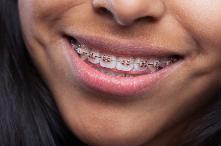Traditional Brackets