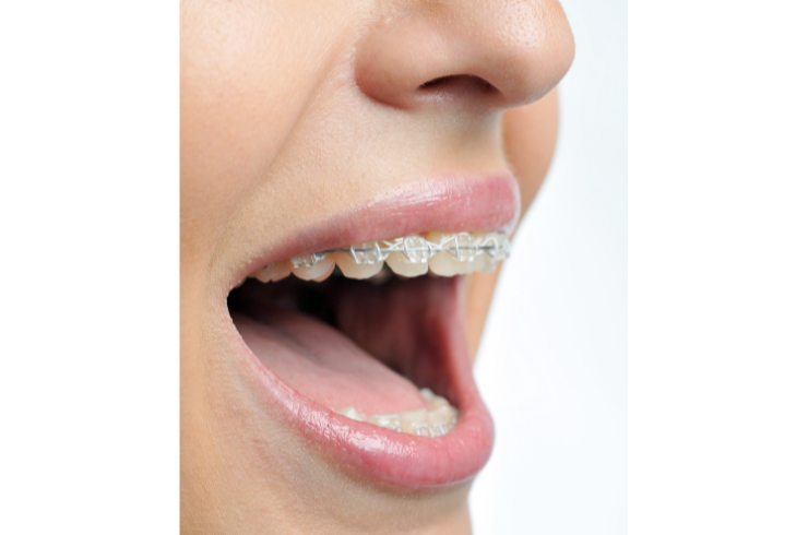 Ceramic Brackets
