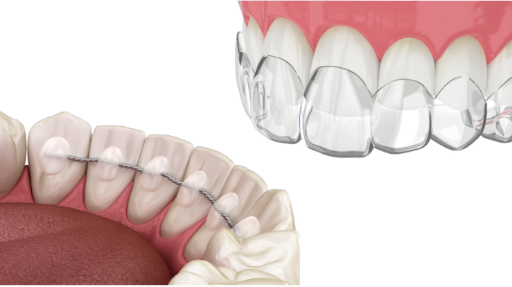 Retainers